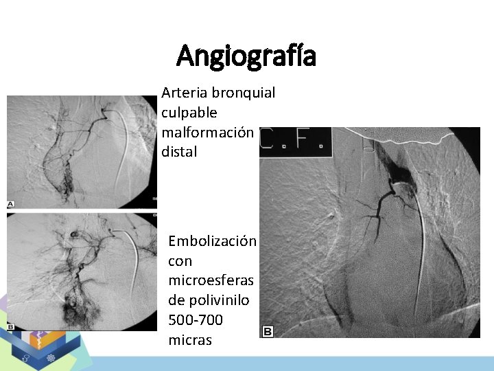 Angiografía Arteria bronquial culpable malformación distal Embolización con microesferas de polivinilo 500 -700 micras
