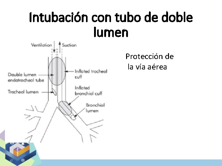 Intubación con tubo de doble lumen Protección de la vía aérea 