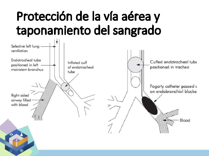 Protección de la vía aérea y taponamiento del sangrado 