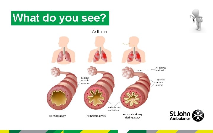 What do you see? Asthma 
