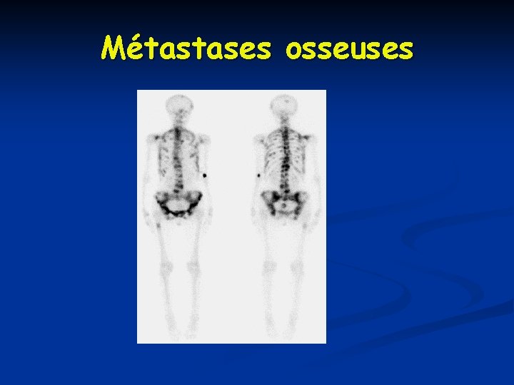 Métastases osseuses Métastases osseuses
