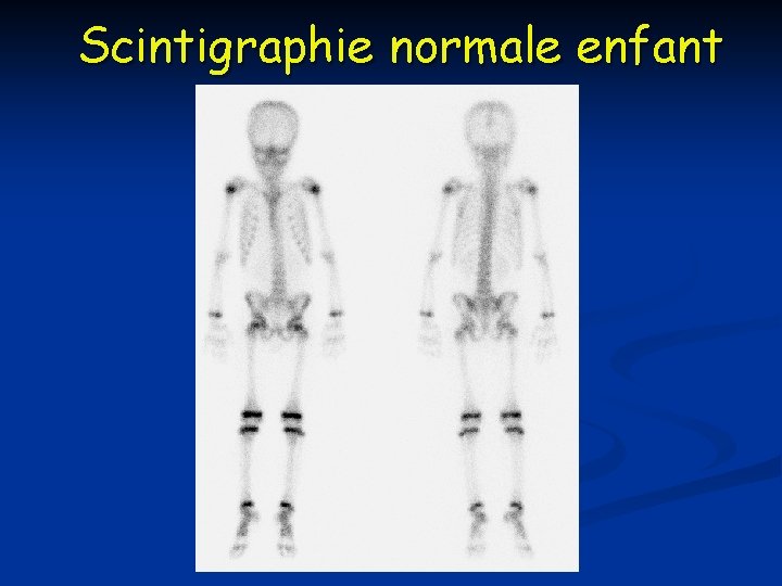 Scintigraphie normale enfant 