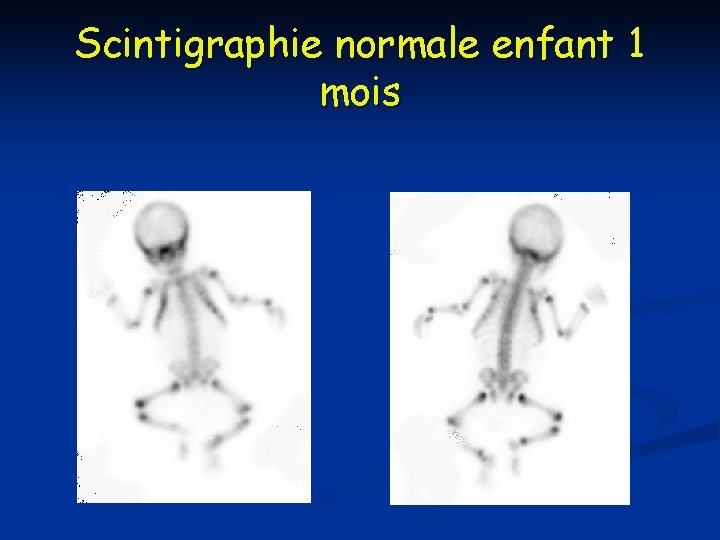 Scintigraphie normale enfant 1 mois Scintigraphie normale enfant 1 mois