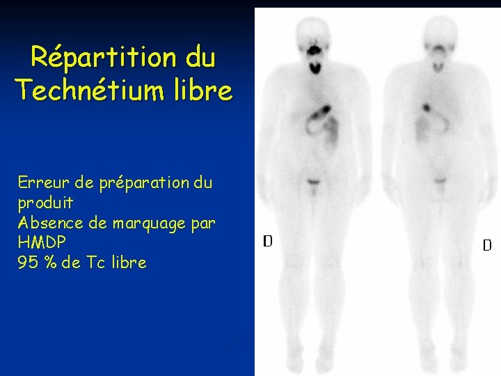 Répartition du Technétium libre Erreur de préparation du produit Absence de marquage par HMDP