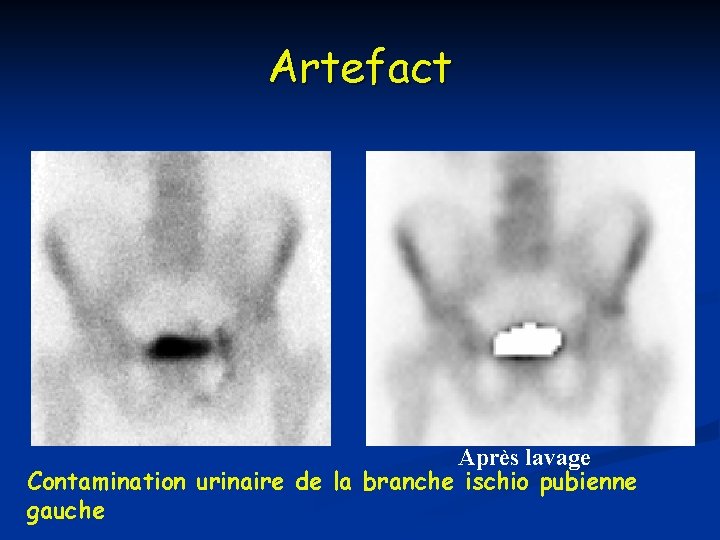 Artefact Après lavage Contamination urinaire de la branche ischio pubienne gauche 