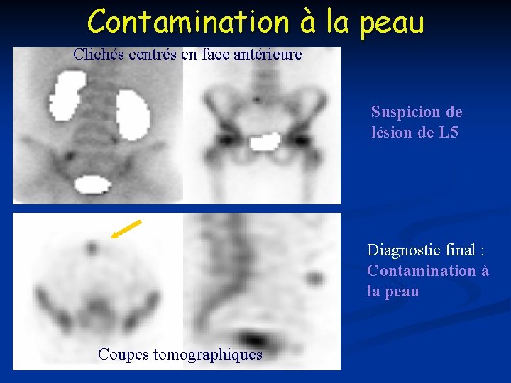 Contamination à la peau Clichés centrés en face antérieure Suspicion de lésion de L