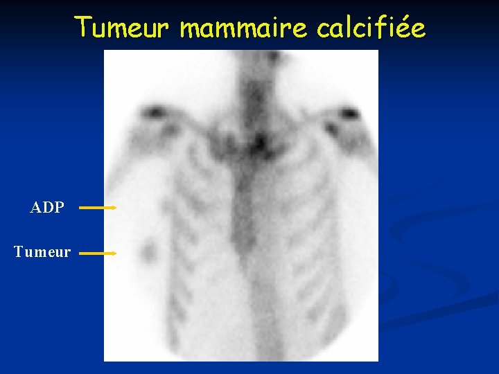 Tumeur mammaire calcifiée ADP Tumeur Tumeur mammaire calcifiée ADP Tumeur