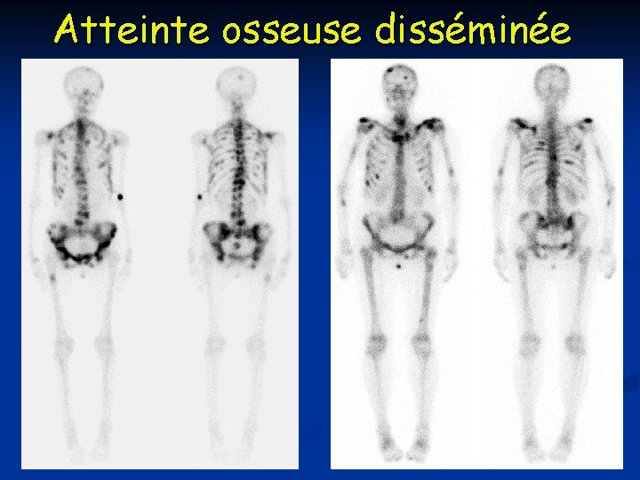 Atteinte osseuse disséminée 