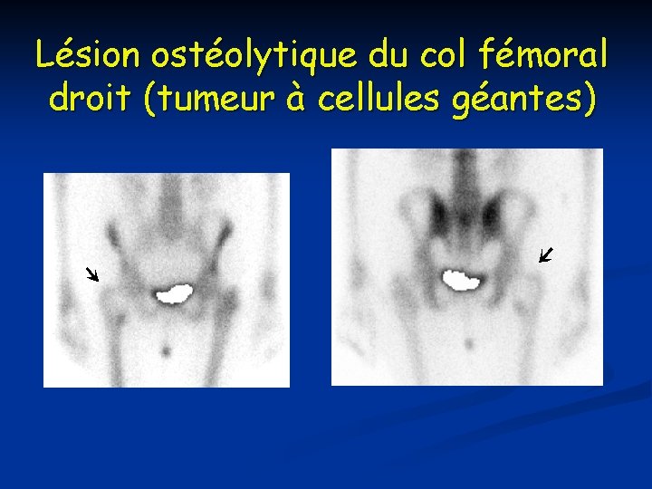 Lésion ostéolytique du col fémoral droit (tumeur à cellules géantes) 