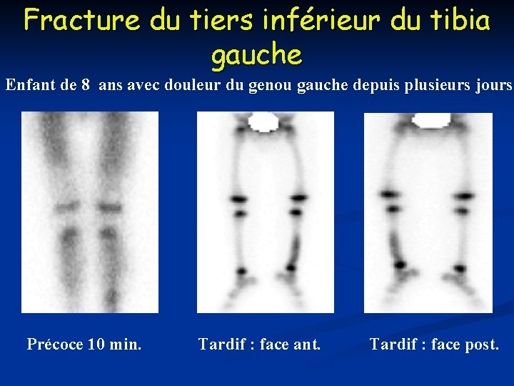 Fracture du tiers inférieur du tibia gauche Enfant de 8 ans avec douleur du