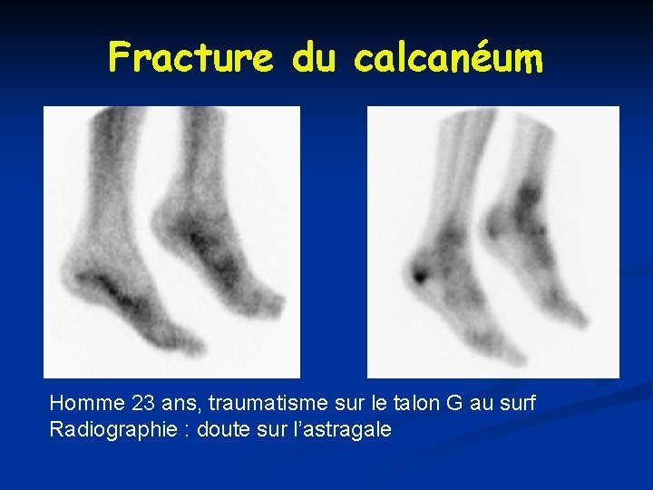 Fracture du calcanéum Homme 23 ans, traumatisme sur le talon G au surf Radiographie