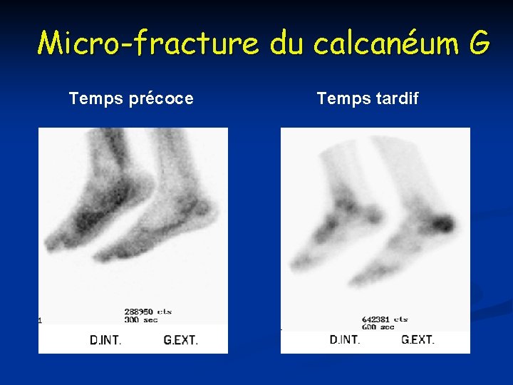 Micro-fracture du calcanéum G Temps précoce Temps tardif 