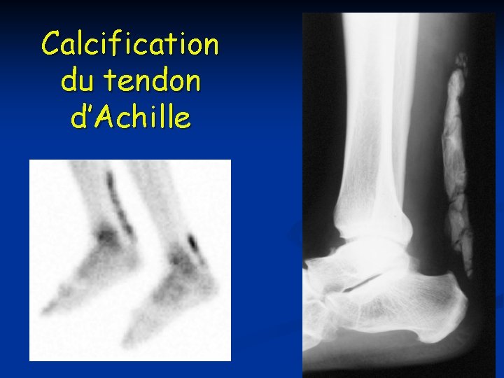 Calcification du tendon d’Achille 