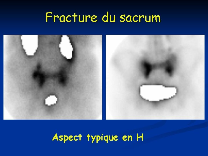 Fracture du sacrum Aspect typique en H 