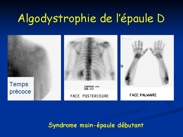 Algodystrophie de l’épaule D Temps précoce Syndrome main-épaule débutant Algodystrophie de l’épaule D Temps précoce Syndrome main-épaule débutant