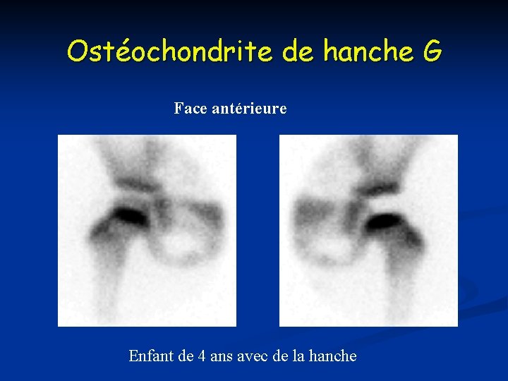 Ostéochondrite de hanche G Face antérieure Enfant de 4 ans avec de la hanche