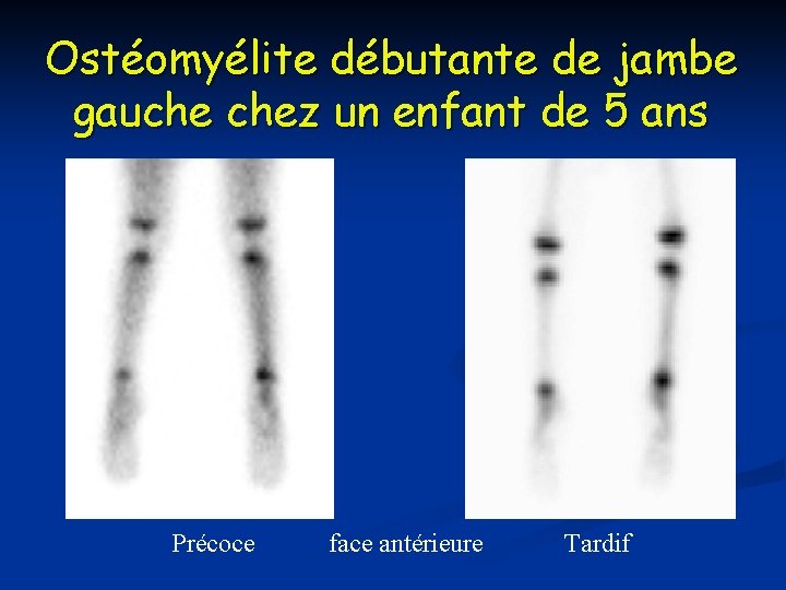 Ostéomyélite débutante de jambe gauche chez un enfant de 5 ans Précoce face antérieure