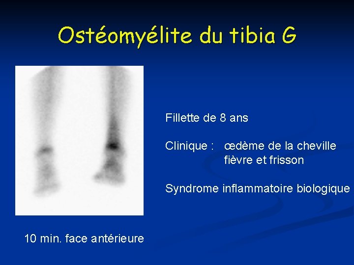 Ostéomyélite du tibia G Fillette de 8 ans Clinique : œdème de la cheville Ostéomyélite du tibia G Fillette de 8 ans Clinique : œdème de la cheville