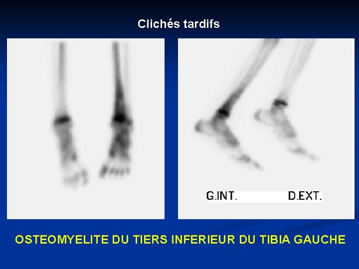 Clichés tardifs OSTEOMYELITE DU TIERS INFERIEUR DU TIBIA GAUCHE 