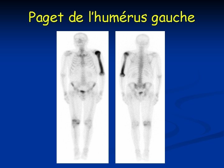 Paget de l’humérus gauche Paget de l’humérus gauche