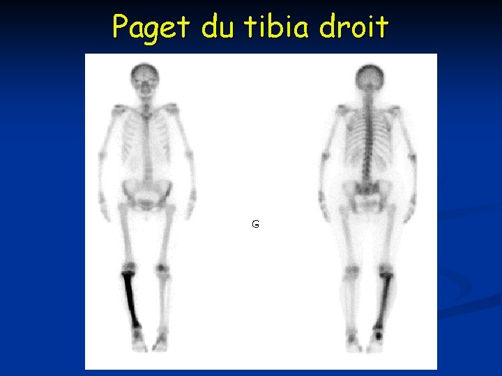 Paget du tibia droit 