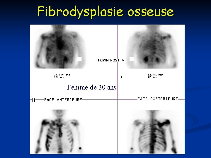 Fibrodysplasie osseuse Femme de 30 ans 