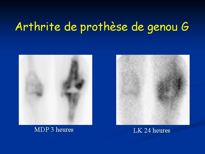Arthrite de prothèse de genou G MDP 3 heures LK 24 heures 