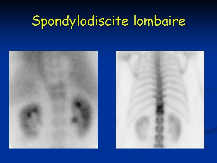 Spondylodiscite lombaire Spondylodiscite lombaire