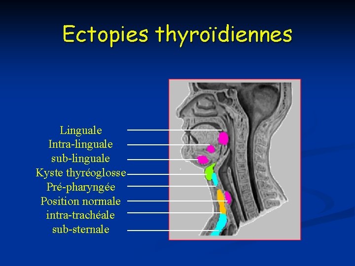 Ectopies thyroïdiennes Linguale Intra-linguale sub-linguale Kyste thyréoglosse Pré-pharyngée Position normale intra-trachéale sub-sternale 