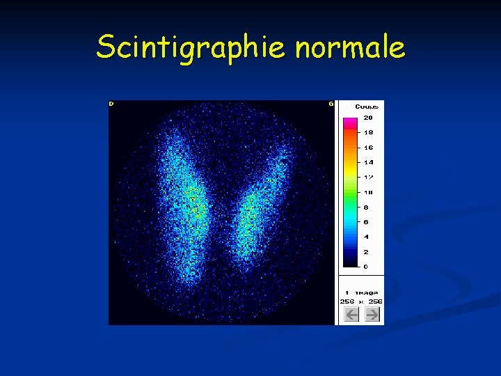 Scintigraphie normale 