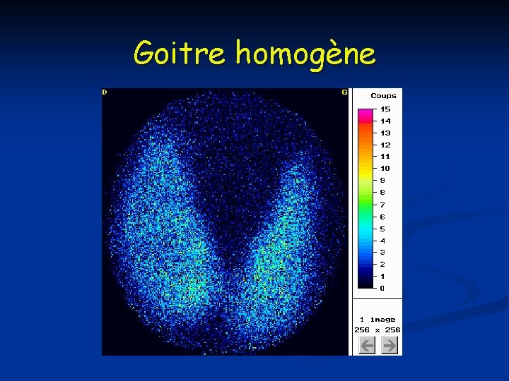 Goitre homogène 