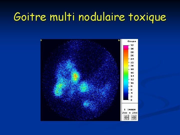 Goitre multi nodulaire toxique 