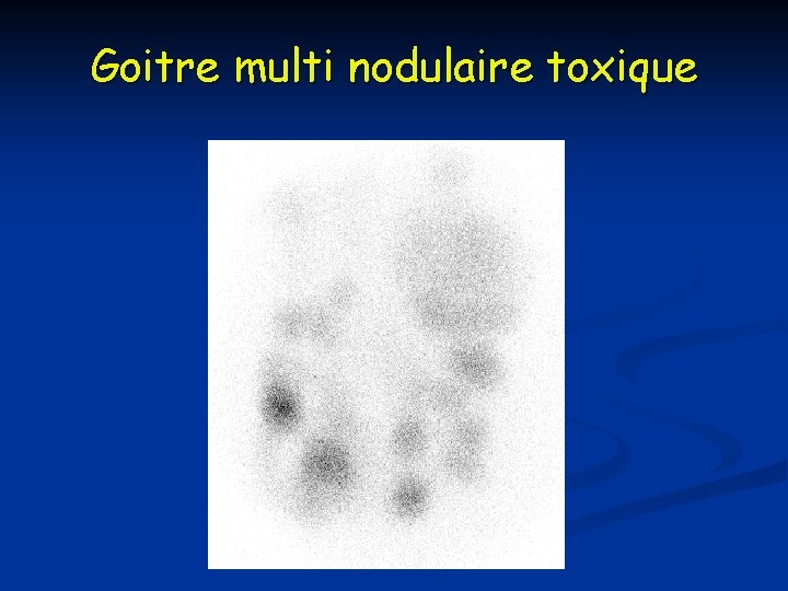 Goitre multi nodulaire toxique Goitre multi nodulaire toxique