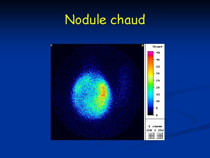 Nodule chaud Nodule chaud