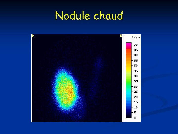 Nodule chaud 