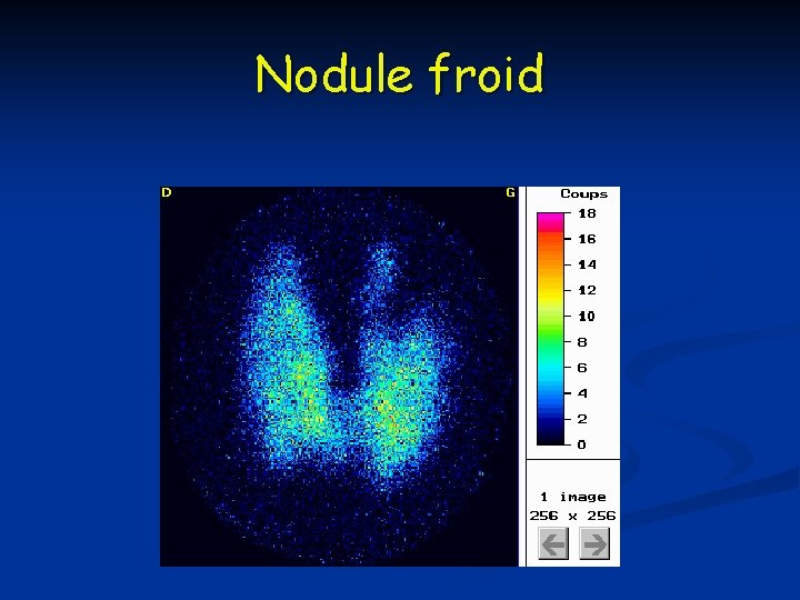 Nodule froid 