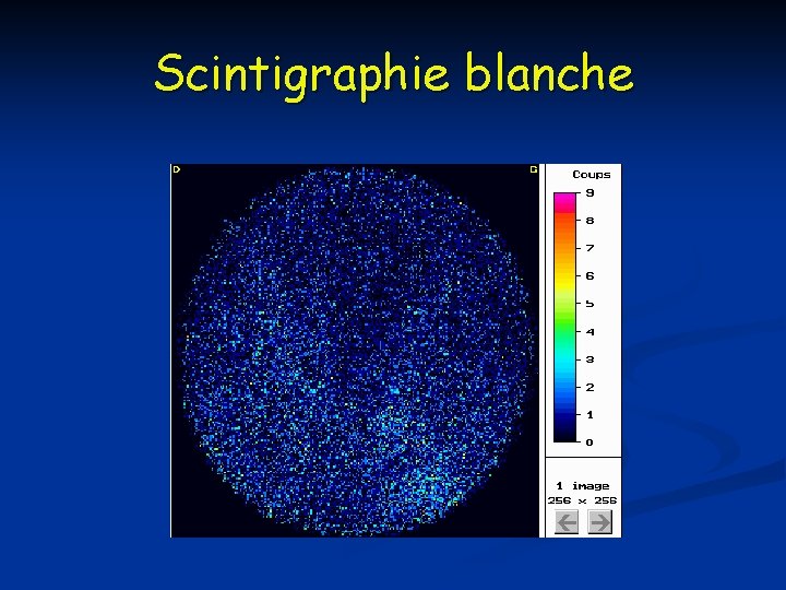 Scintigraphie blanche 