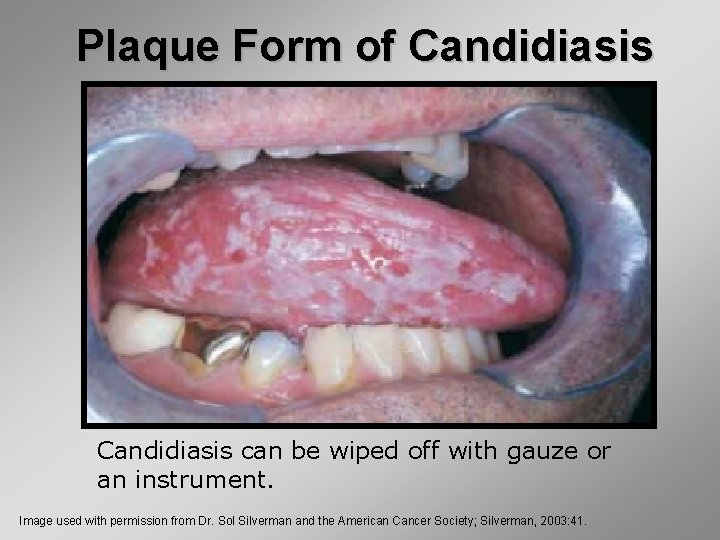 Plaque Form of Candidiasis can be wiped off with gauze or an instrument. Image