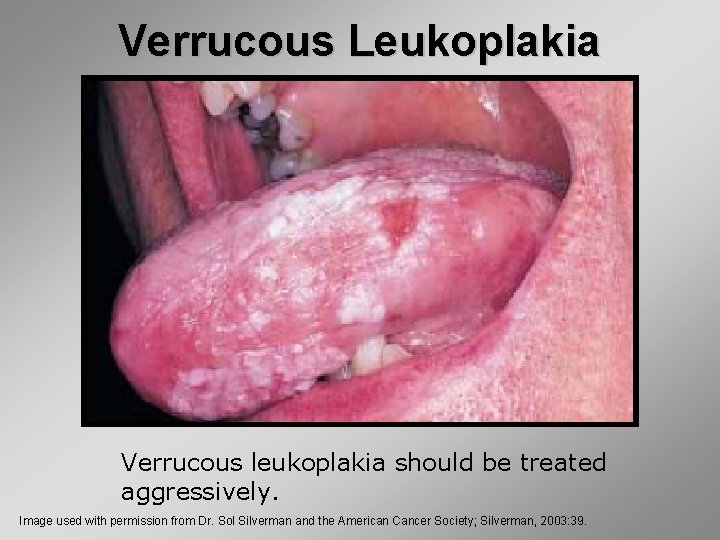 Verrucous Leukoplakia Verrucous leukoplakia should be treated aggressively. Image used with permission from Dr.