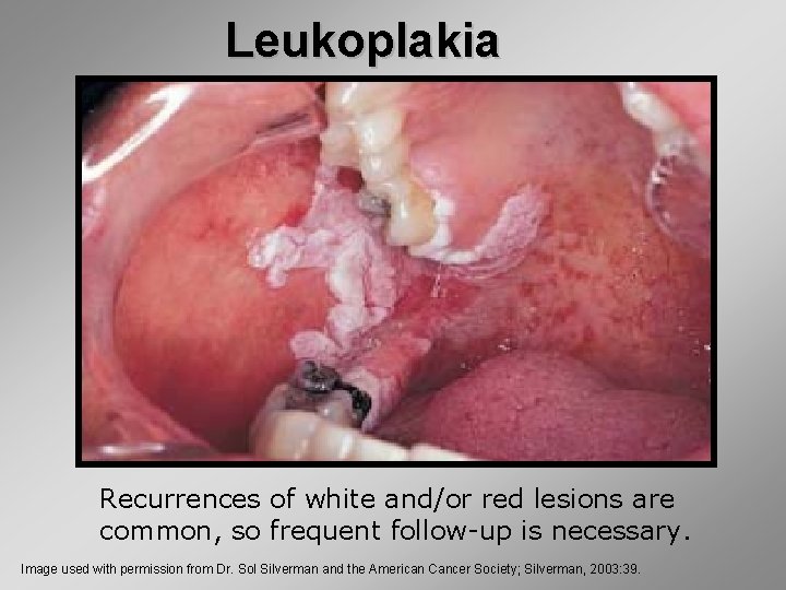Leukoplakia Recurrences of white and/or red lesions are common, so frequent follow-up is necessary.