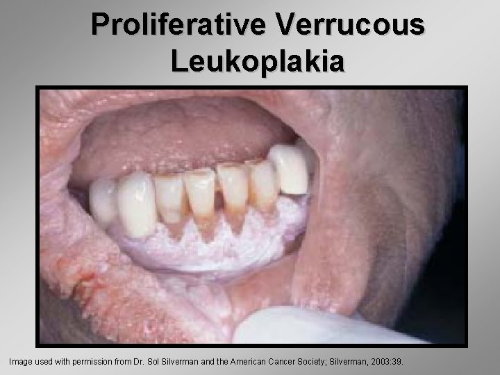 Proliferative Verrucous Leukoplakia Image used with permission from Dr. Sol Silverman and the American
