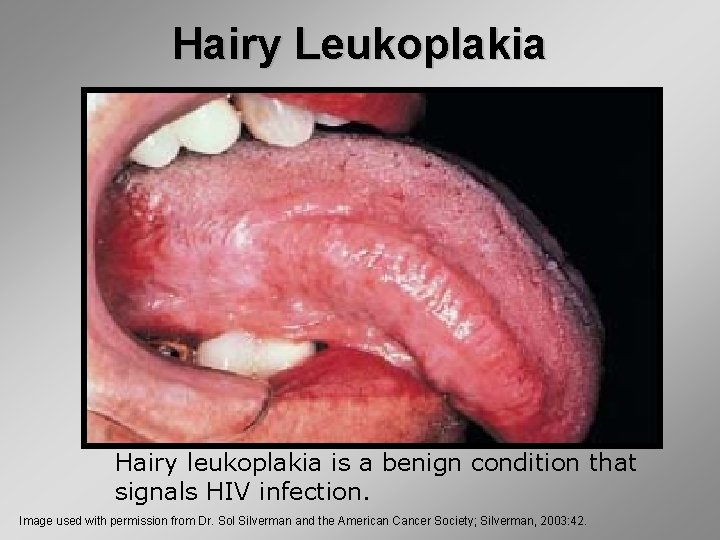 Hairy Leukoplakia Hairy leukoplakia is a benign condition that signals HIV infection. Image used