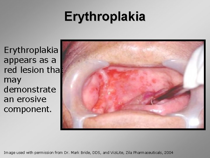 Erythroplakia appears as a red lesion that may demonstrate an erosive component. Image used