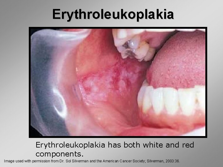 Erythroleukoplakia has both white and red components. Image used with permission from Dr. Sol