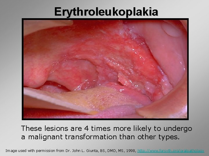 Erythroleukoplakia These lesions are 4 times more likely to undergo a malignant transformation than