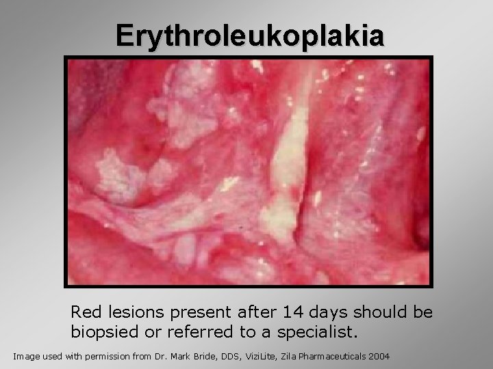 Erythroleukoplakia Red lesions present after 14 days should be biopsied or referred to a