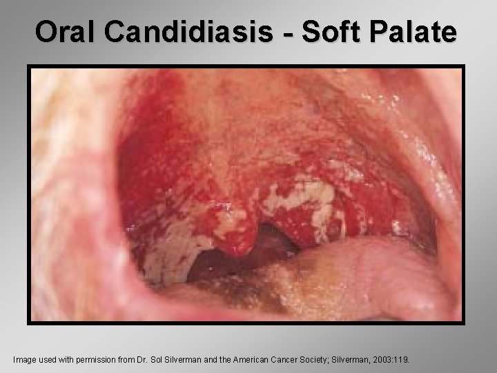 Oral Candidiasis - Soft Palate Image used with permission from Dr. Sol Silverman and