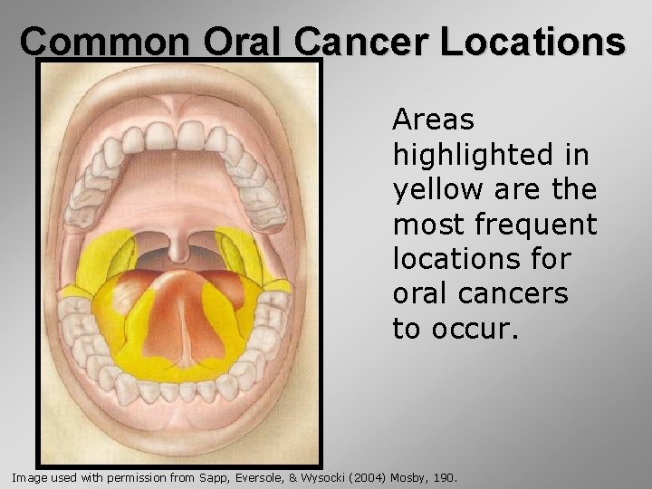 Common Oral Cancer Locations Areas highlighted in yellow are the most frequent locations for