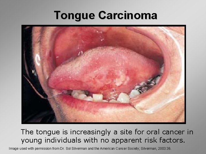 Tongue Carcinoma The tongue is increasingly a site for oral cancer in young individuals