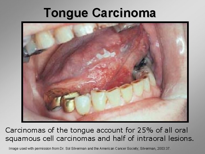 Tongue Carcinomas of the tongue account for 25% of all oral squamous cell carcinomas